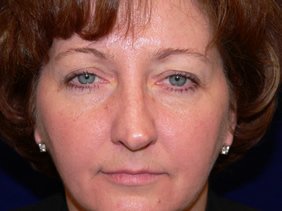nose surgery rhinoplasty photos