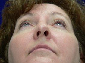nose surgery rhinoplasty photos
