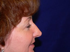 nose surgery rhinoplasty photos