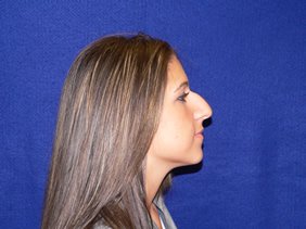 nose surgery rhinoplasty photos