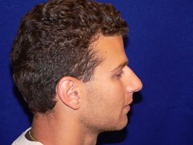nose surgery rhinoplasty photos