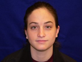 nose surgery rhinoplasty photos