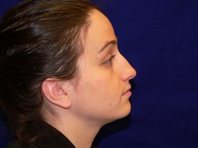 nose surgery rhinoplasty photos