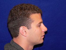 nose surgery rhinoplasty photos