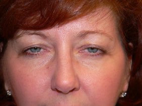 nose surgery rhinoplasty photos