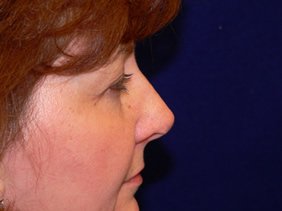 nose surgery rhinoplasty photos