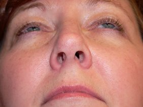 nose surgery rhinoplasty photos