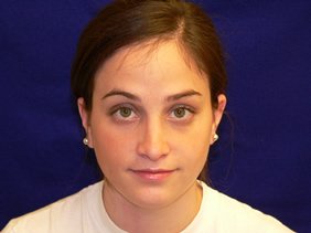 nose surgery rhinoplasty photos