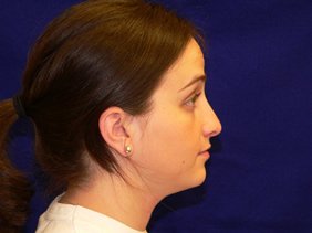 nose surgery rhinoplasty photos