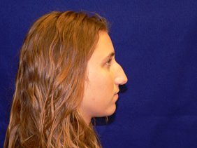 nose surgery rhinoplasty photos