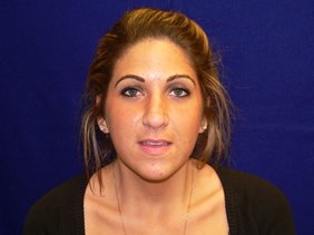 nose surgery rhinoplasty photos