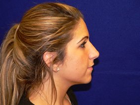 nose surgery rhinoplasty photos