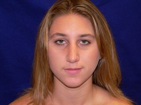nose surgery rhinoplasty photos