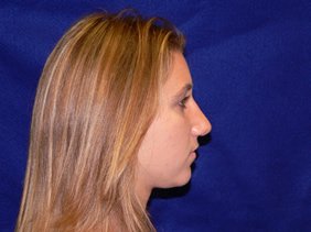 nose surgery rhinoplasty photos