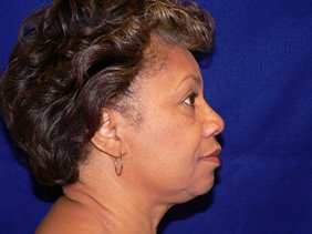 nose surgery rhinoplasty photos
