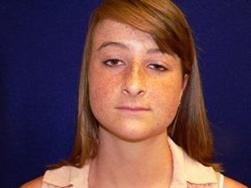 rhinoplasty nose surgery richmond virginia photos