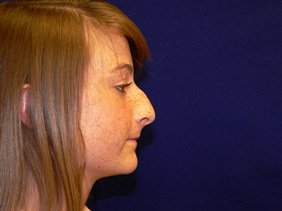 rhinoplasty nose surgery richmond virginia photos