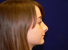 rhinoplasty nose surgery richmond virginia photos