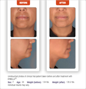 Kybella Before and After Photos - DeConti Plastic Surgery