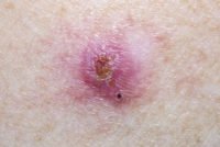 Basal Cell Skin Cancer Photo
