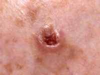 Basal Cell Skin Cancer picture