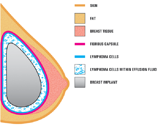 BIA-ALCL Breast Implant-Associated Large Cell Lymphoma