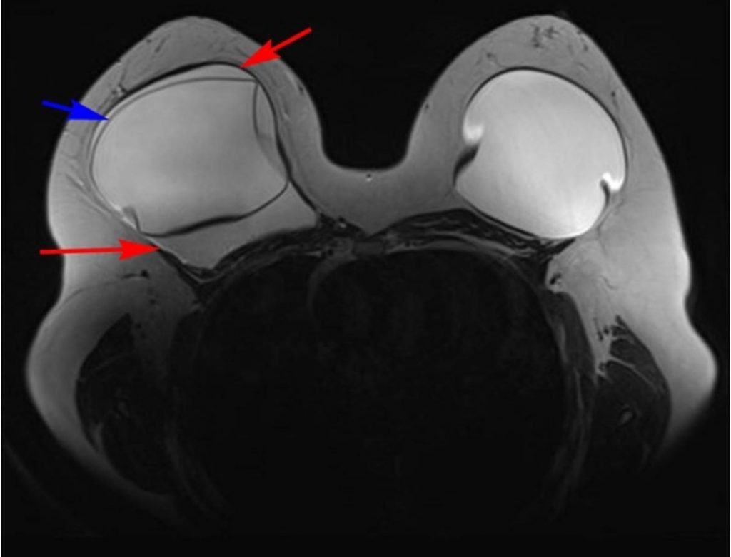 BIA-ALCL MRI Richmond VA