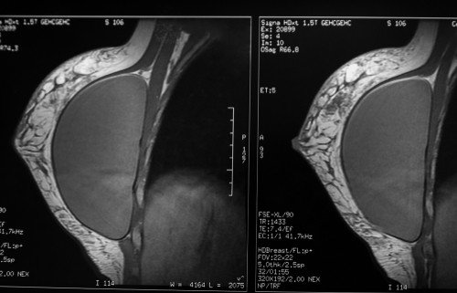 Breast Implant Illness MRI