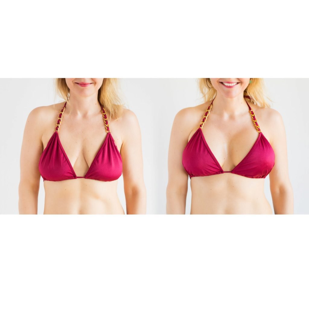 Breast Lift Before and After Picture
