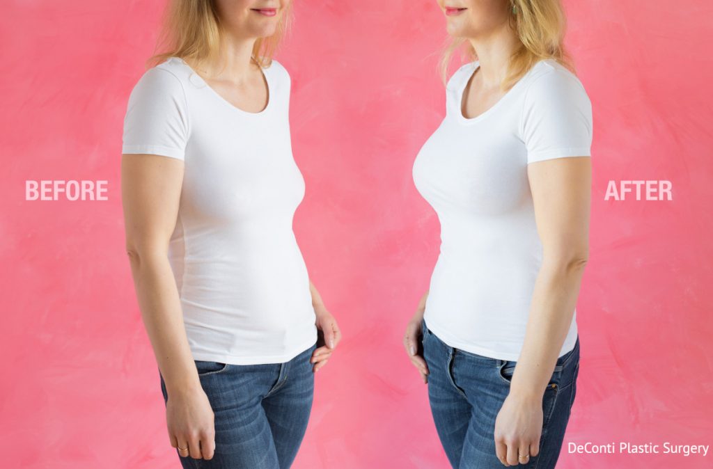 Breast Lift Before and After Photo