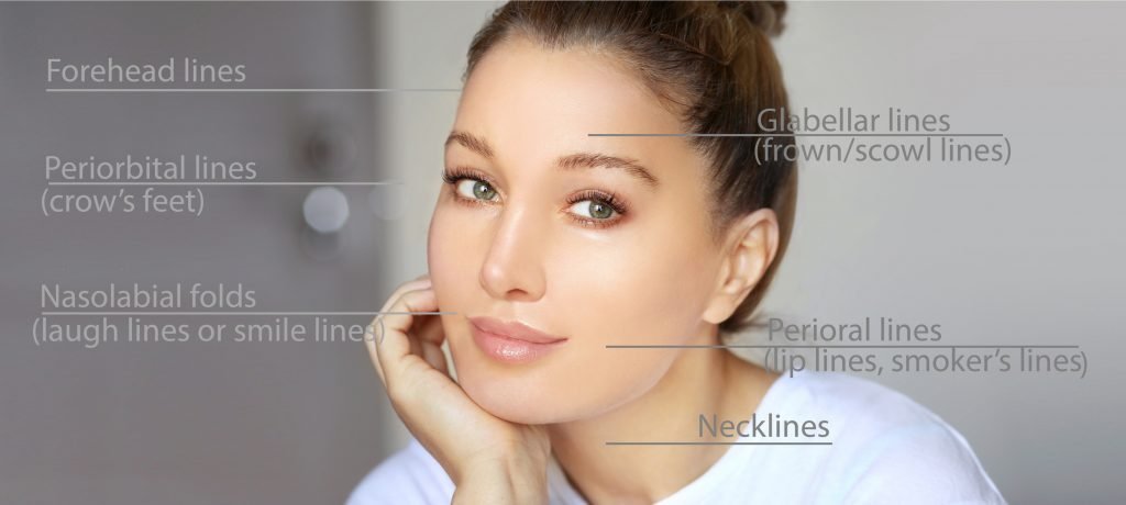 Botox For Migraines