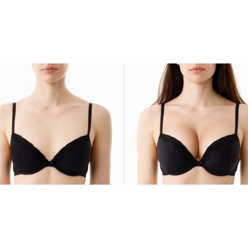 Bra After Breast Augmentation