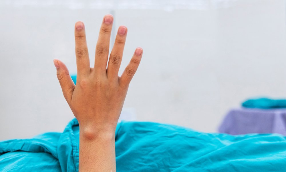 Ganglion Cyst