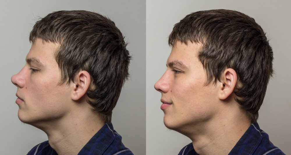 Male Rhinoplasty Near Me