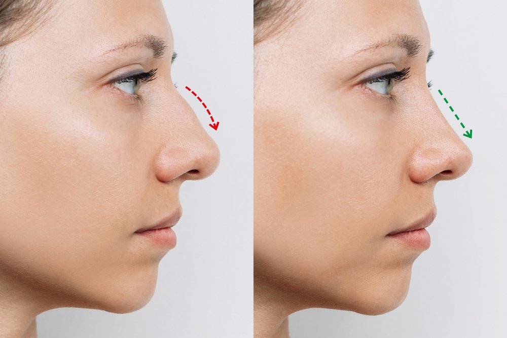 Non Surgical Rhinoplasty Near Me