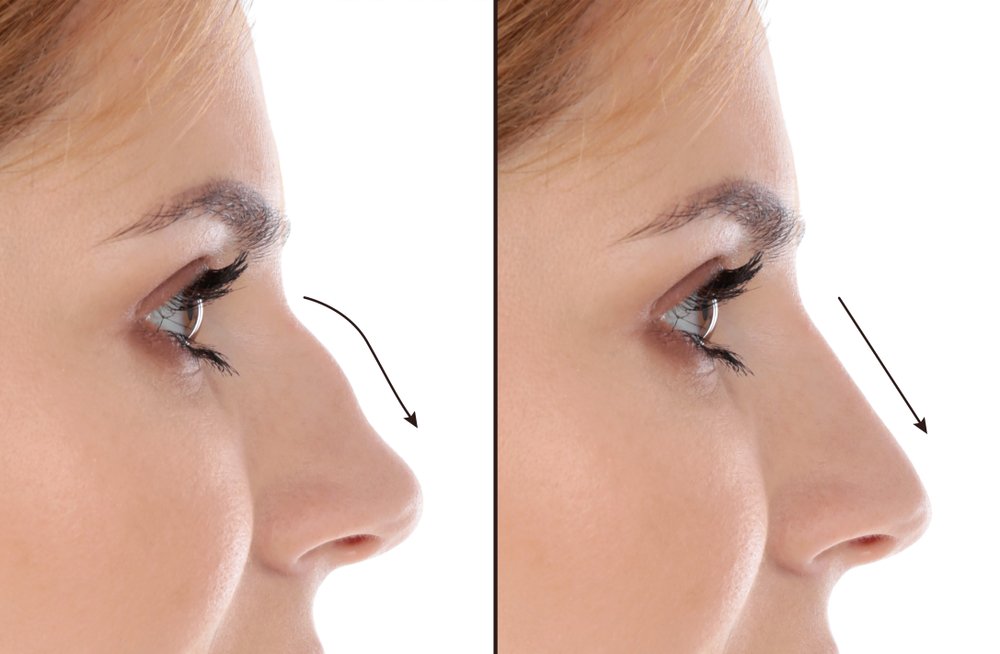 Non Surgical Rhinoplasty