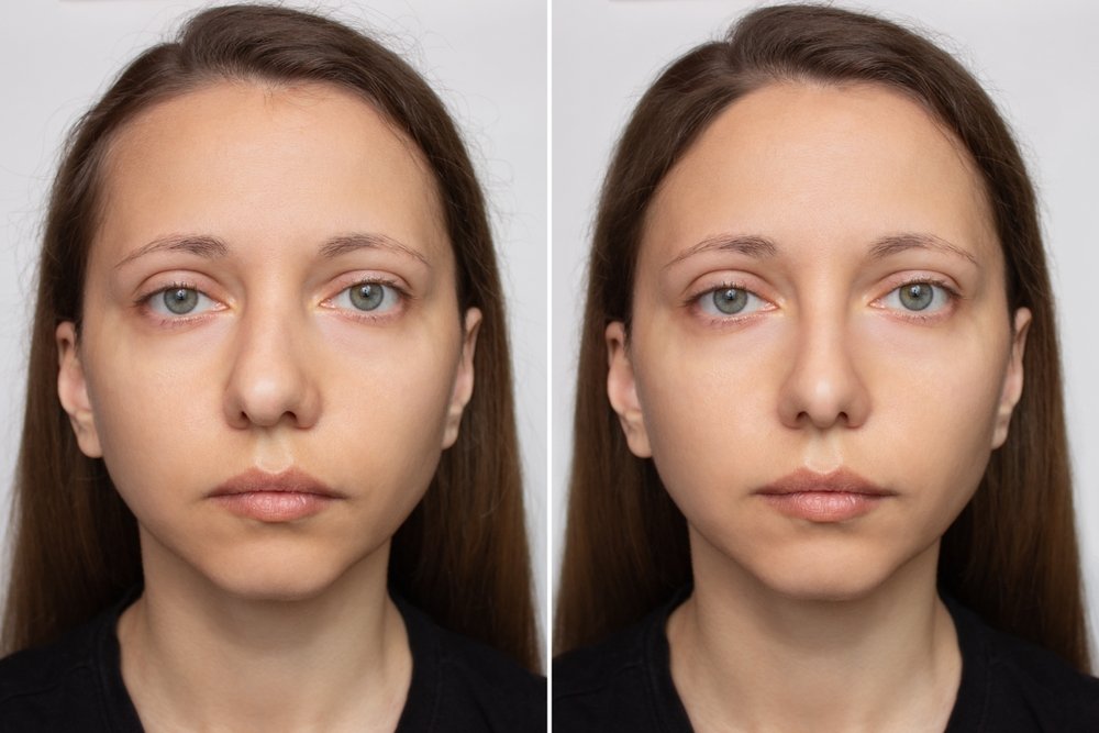 Rhinoplasty Before and After