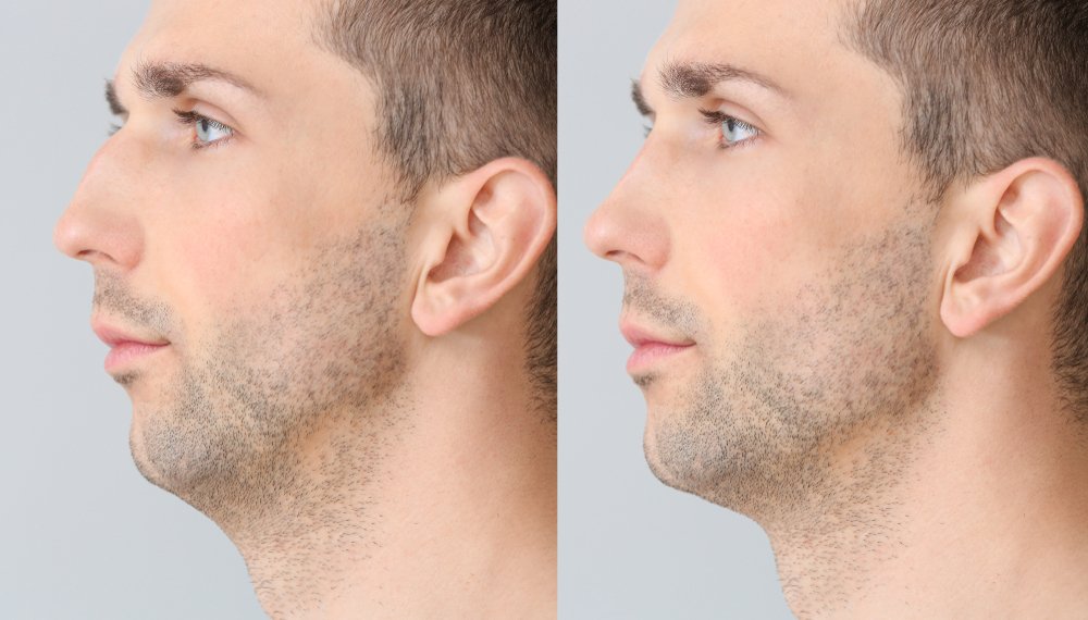 Rhinoplasty Cost
