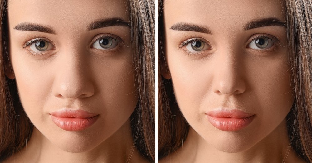 Rhinoplasty
