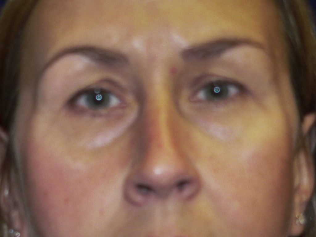 Upper and Lower Blepharoplasty