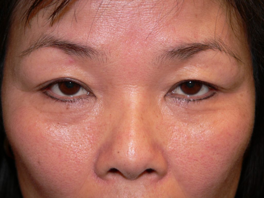 Blepharoplasty Before and After Photo