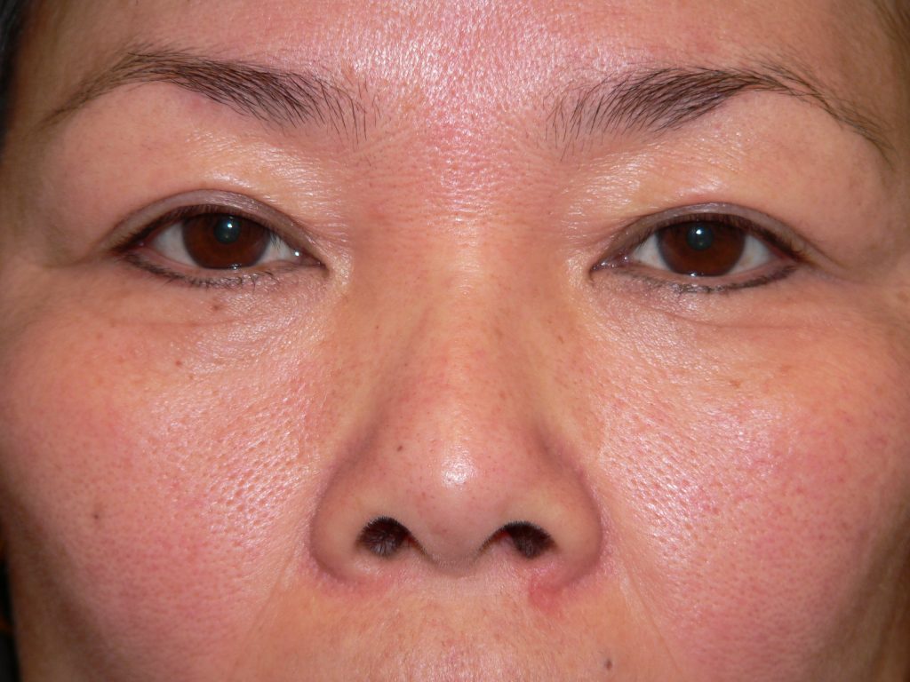 Blepharoplasty Before and After Photo