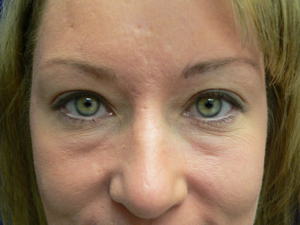 Blepharoplasty Before and After Picture