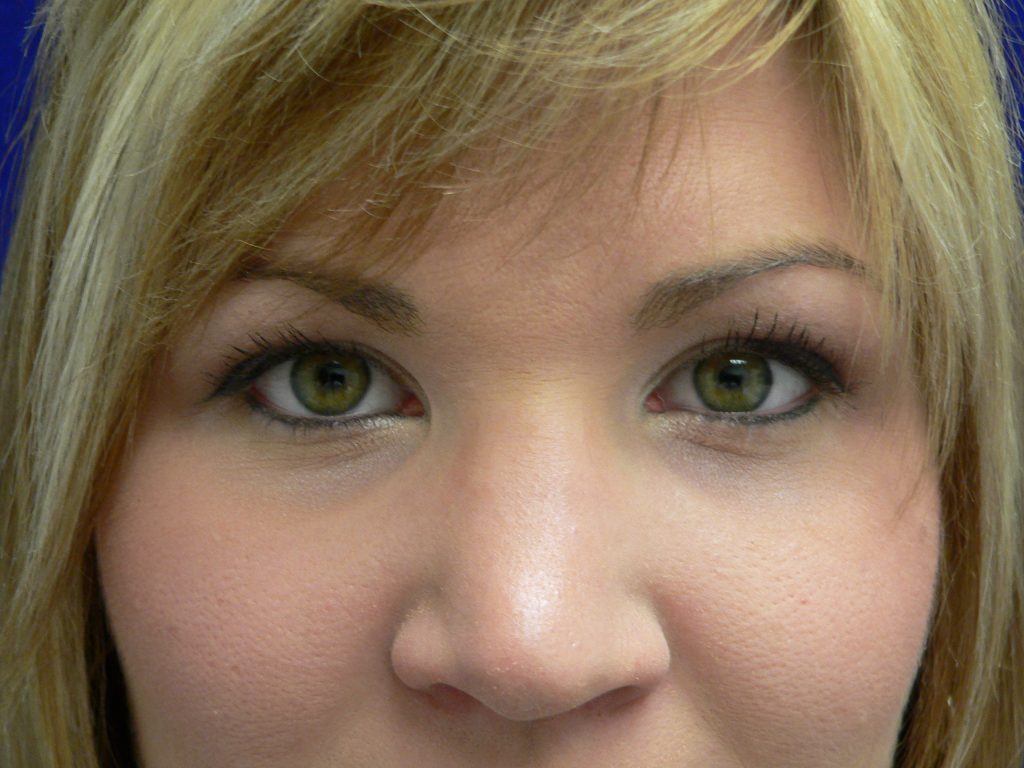 Blepharoplasty