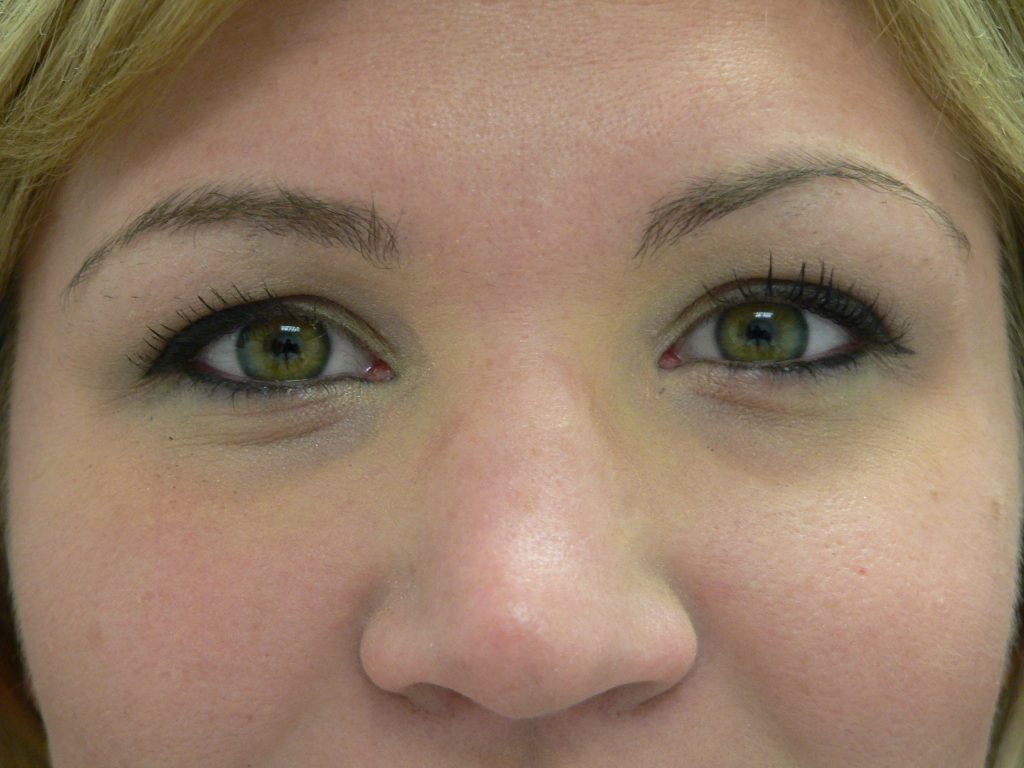 Blepharoplasty