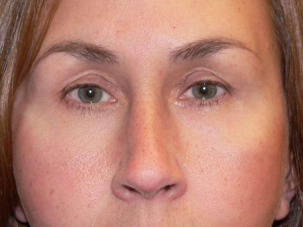 Upper and Lower Blepharoplasty