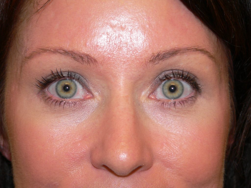 Blepharoplasty Before and After Picture