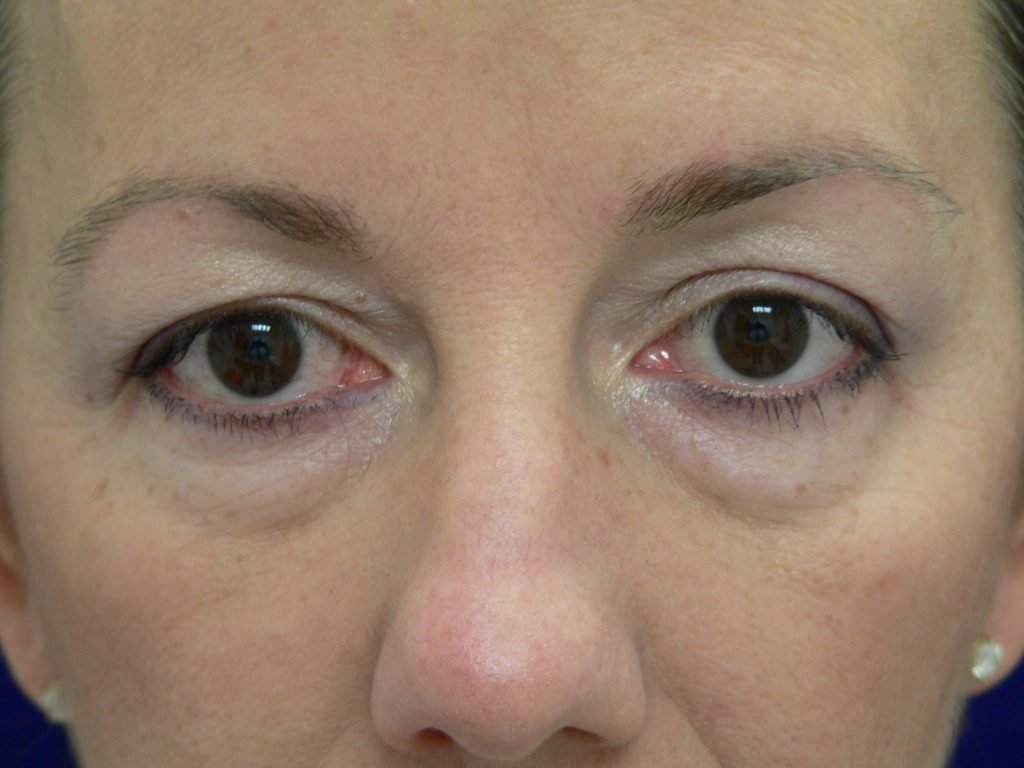 Blepharoplasty Before and After Photo