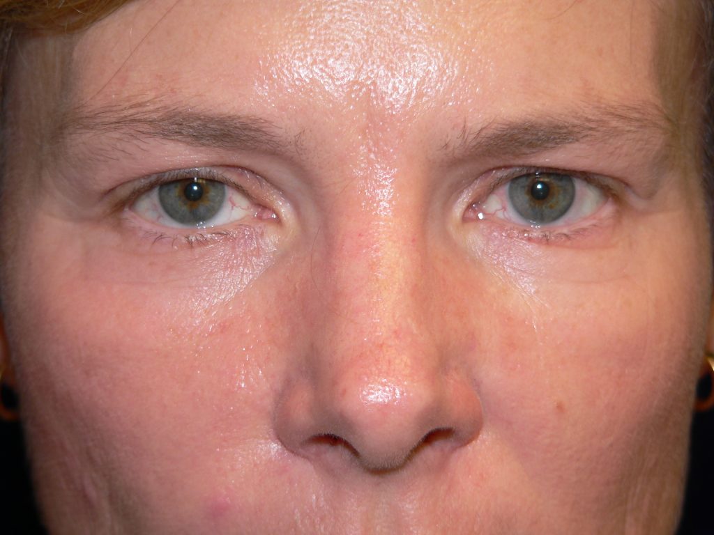 Blepharoplasty Before and After Photo
