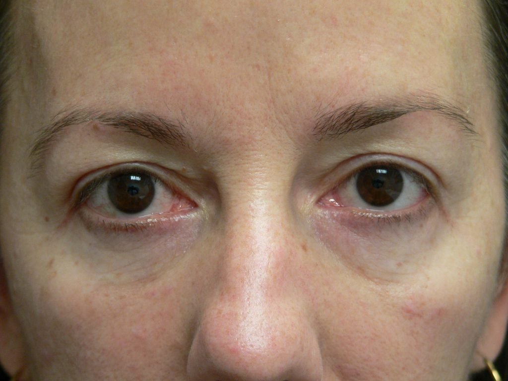 Blepharoplasty Before and After Photo